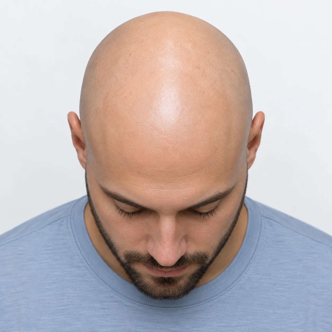 Head seen from above, divided into six hair loss zones
