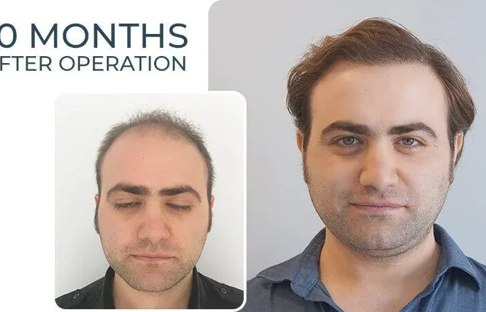 Beyaz Saç Ekilir Mi? 2 Beyaz Sac Ekilir Mi