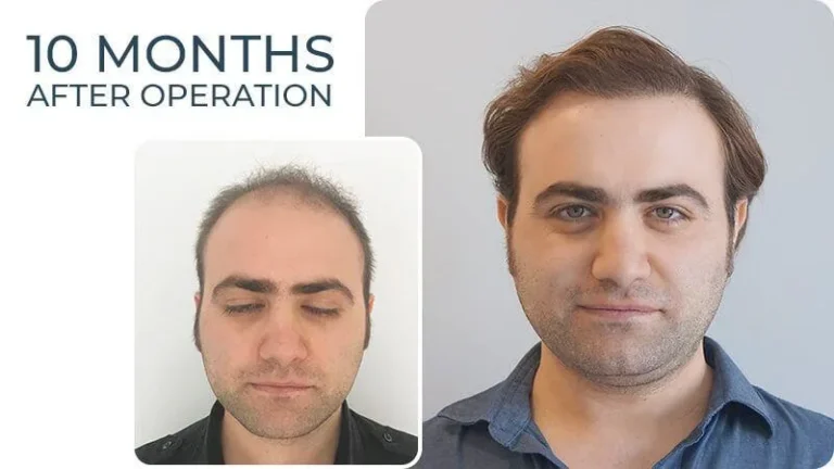 Beyaz Sac Ekilir Mi