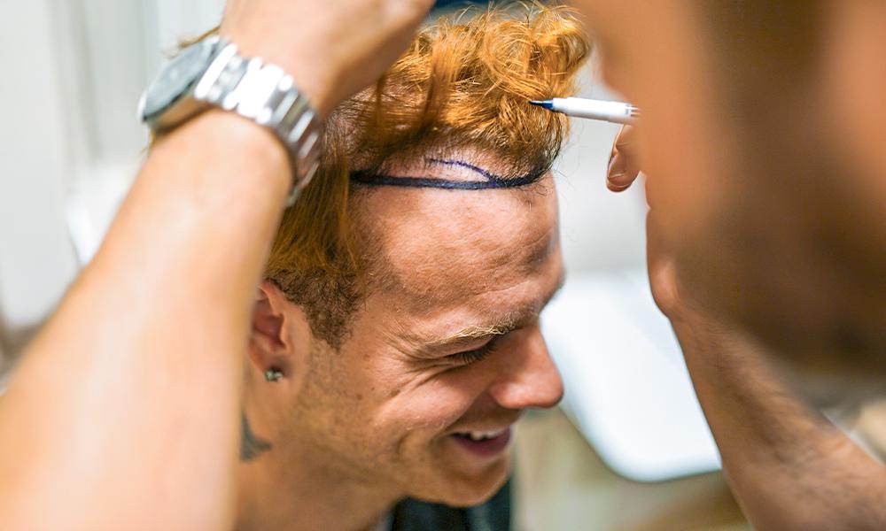 Color Hair After A Hair Transplant