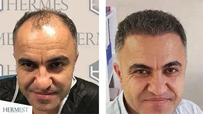 How long should numbness after hair transplantation