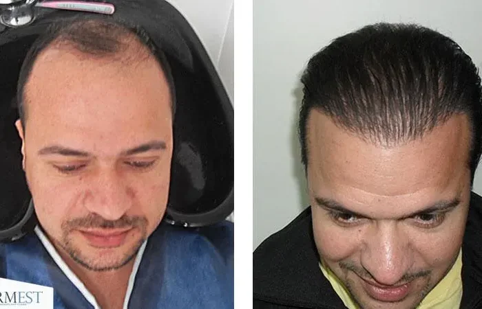 Saç Ekimi Sonrası Kabuklar Nasıl Temizlenir? 21 Sac Ekimi Sonrasi Kabuklar Nasil Temizlenir