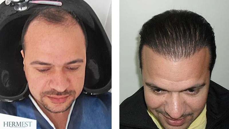 Sac Ekimi Sonrasi Kabuklar Nasil Temizlenir