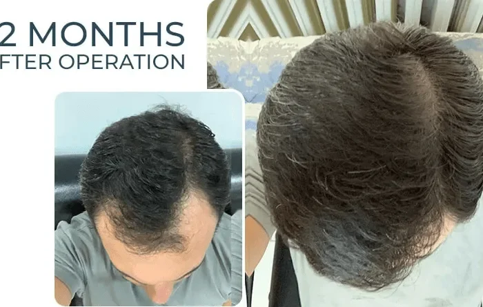 Saç Ekiminden Kaç Gün Sonra Sigara İçilmez? 20 Sac Ekiminden Kac Gun Sonra Sigara İcilmez