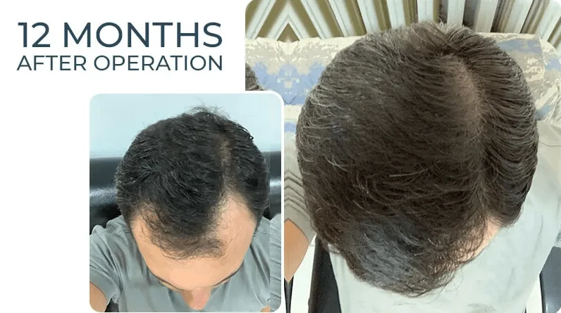 Sac Ekiminden Kac Gun Sonra Sigara İcilmez