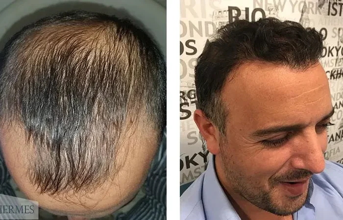 Saç Ekiminden Sonra Ne Zaman Alkol Kullanabilirim? 19 Sac Ekiminden Sonra Ne Zaman Alkol Kullanabilirim