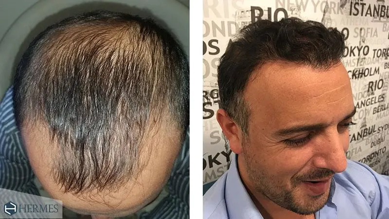 Sac Ekiminden Sonra Ne Zaman Alkol Kullanabilirim