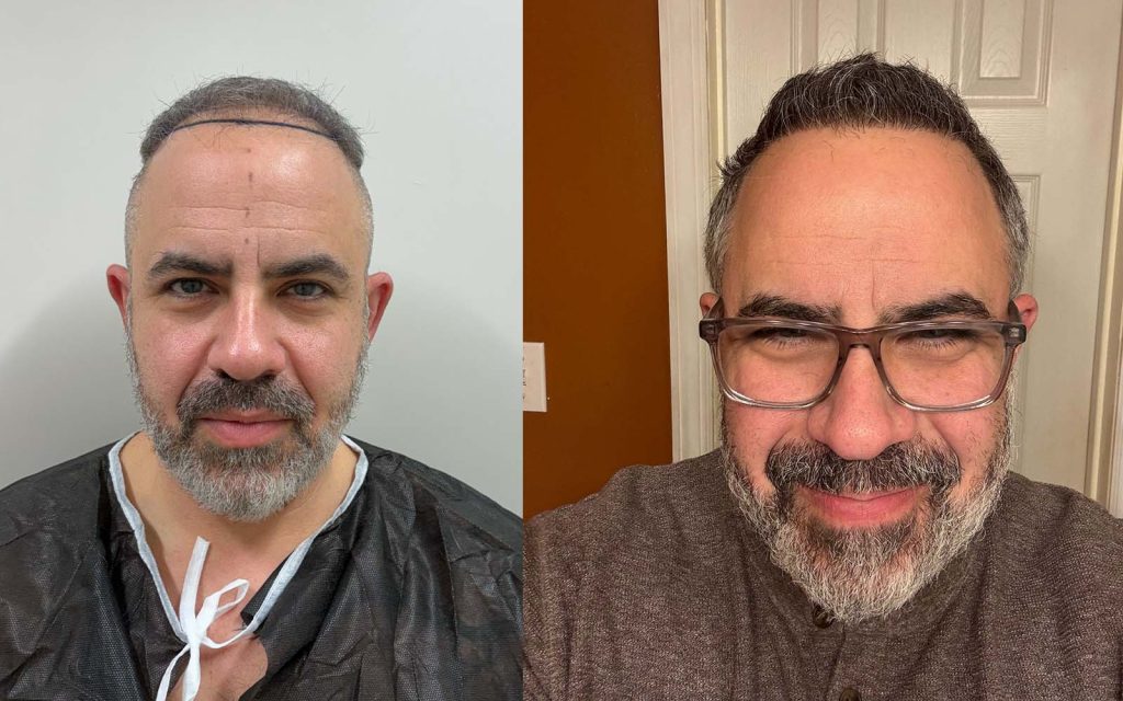 Illustration showing the ideal age range for a successful hair transplant procedure