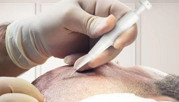 Possible Hair Transplant Complications