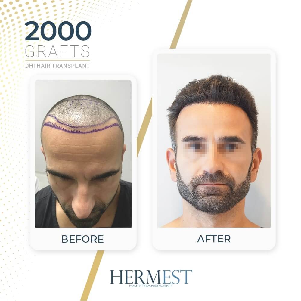 Hair Transplant: Before and After Pictures & Experiences