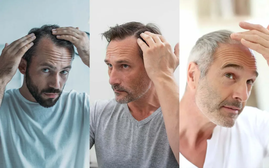 Three men of different ages checking their thinning hairlines, showing hair loss across age groups