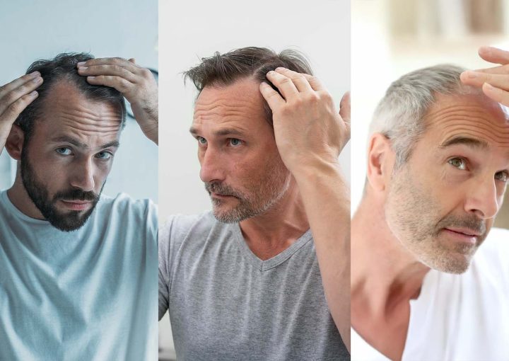Thyroid Disorders and Iron Deficiency and Hair Loss 9 Comparison of hair loss problems in patients of different ages, from young adults to older individuals