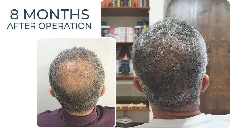 Bald Spot on Crown