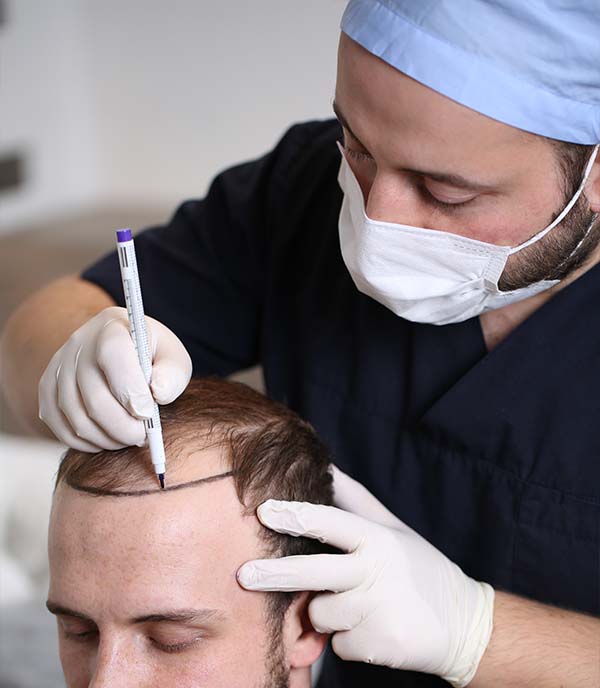 Hairline Lowering Surgery Guide – Costs, Candidacy, Recovery 2 Hair Transplant Procedure