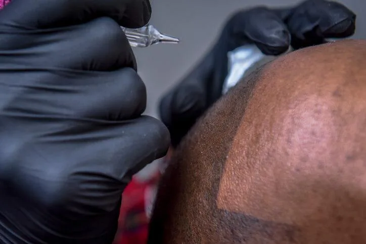Scalp Micropigmentation