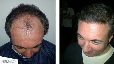 smoke again after hair transplant