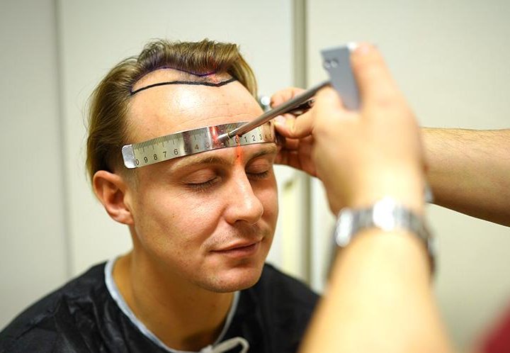 Hair Transplant in Summer: Safety, Sun Rules, Swimming Timeline 4 Hair Transplant in Summer