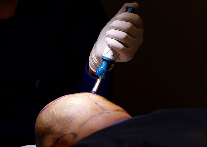Needle-Free Hair Transplant in Turkey | Painless & Safe Option 5 Needle-Free Anesthesia in Hair Transplantation