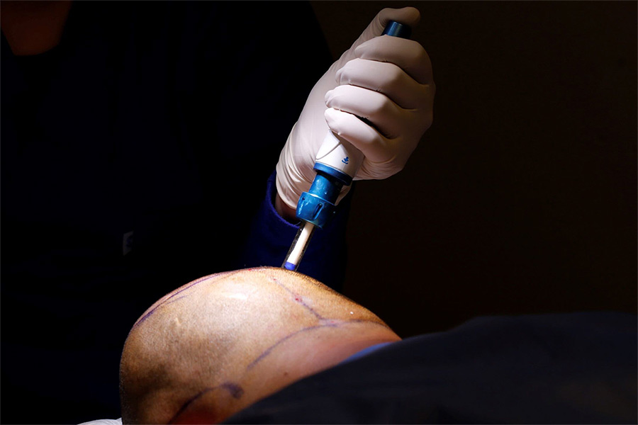 Needle-Free Anesthesia in Hair Transplantation