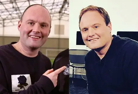 Tubes hair transplant