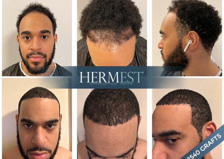 Afro Hair Types – 4A-4B-4C – Complete Guide 7 afro Hair transplant
