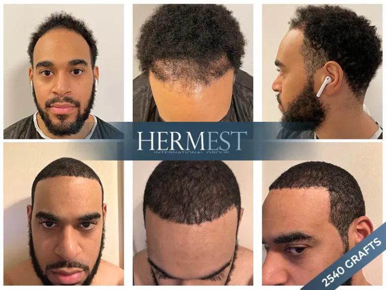 afro Hair transplant