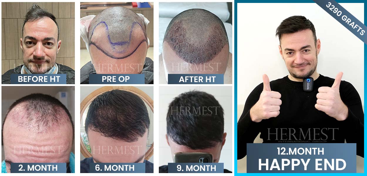 Hair transplant timelapse results in Turkey