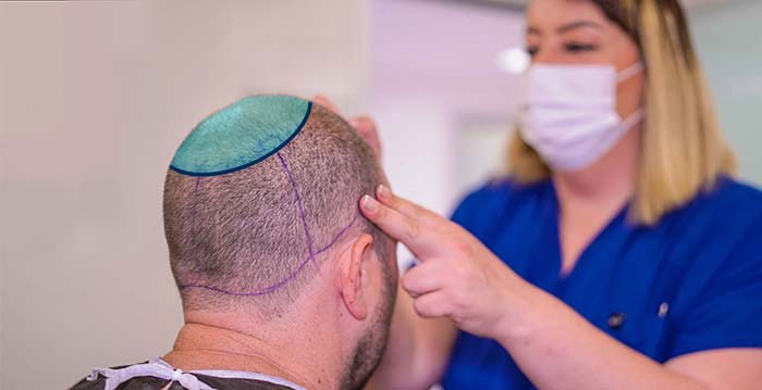 Hair Transplant to the Crown Area 6 Hair Transplant to the Crown Area