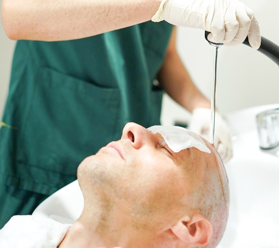 Hair Washing After Hair Transplant