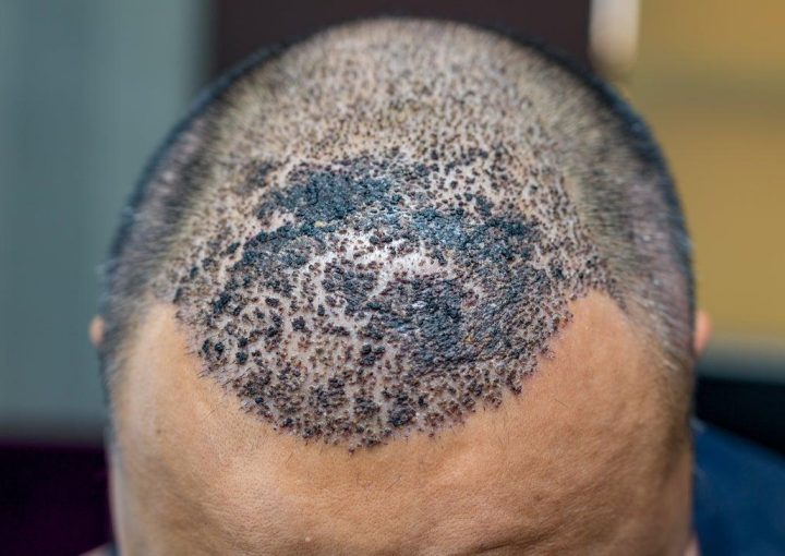 Hair Transplant Infection: Causes, Signs & Prevention Guide 14 Infection after Hair Transplant