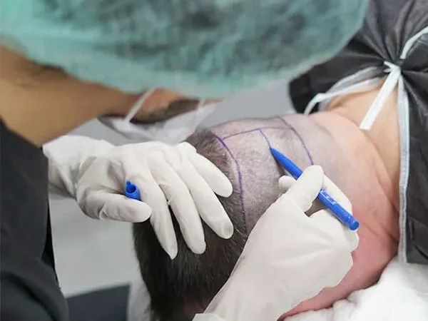 Saç Çizgisi Belirleme 2 Sac Cizgisi Belirleme