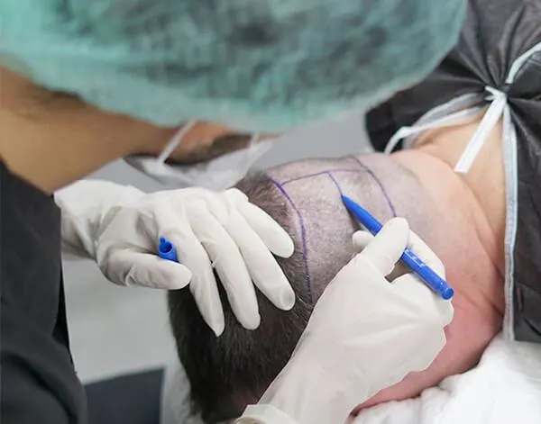 Sac Cizgisi Belirleme