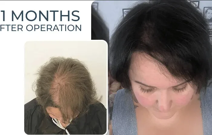 Saç Ekiminde Greft Sayısı Nasıl Belirlenir? 16 Sac Ekiminde Greft Sayisi Nasil Hesaplanir