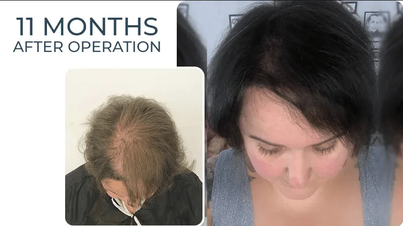 Sac Ekiminde Greft Sayisi Nasil Hesaplanir