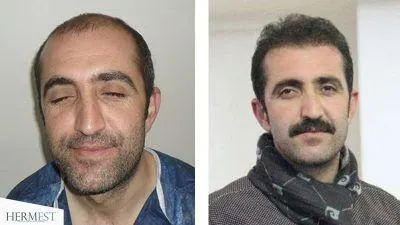 Sac Ekiminden Sonra Sapka Kullanimi