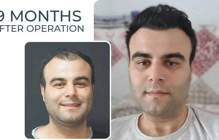 Sakaldan Saç Ekimi Yapılır mı? 17 Sakaldan Sac Ekimi Yapilir mi