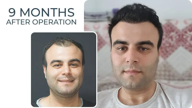 Sakaldan Sac Ekimi Yapilir mi