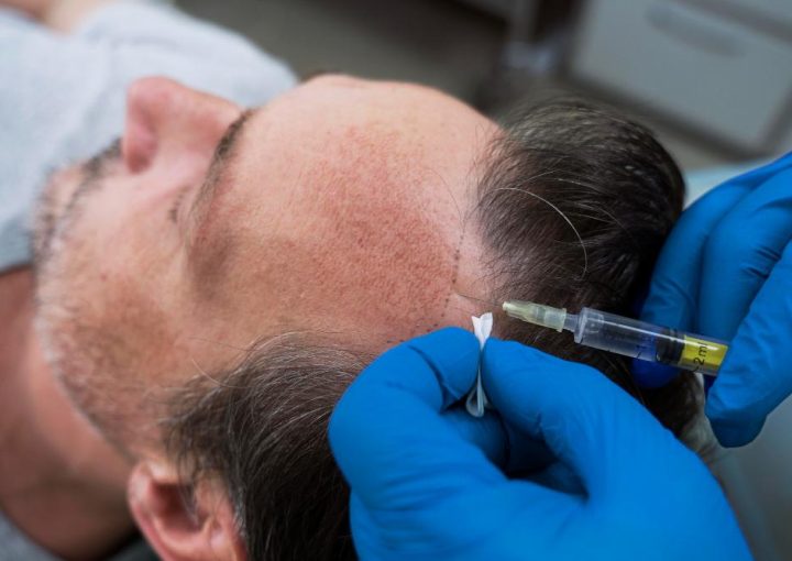 Hair Loss From Dad or Mom? Genetics Explained Clearly 19 Hair Loss Come From