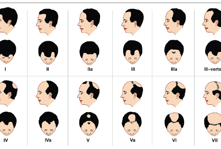 Norwood-Hamilton Scale: Understanding Hair Loss and Treatment Options 20 norwad