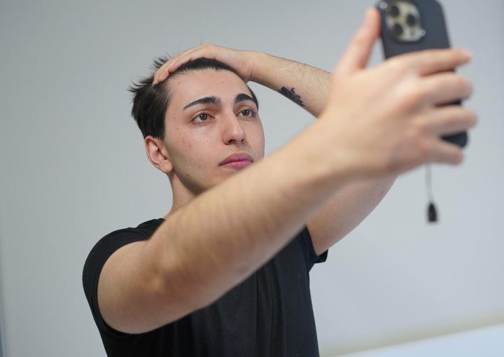 Why Do People Go To Turkey for Hair Transplant? 7 hair transplant before