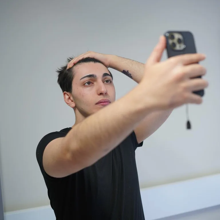 hair transplant before