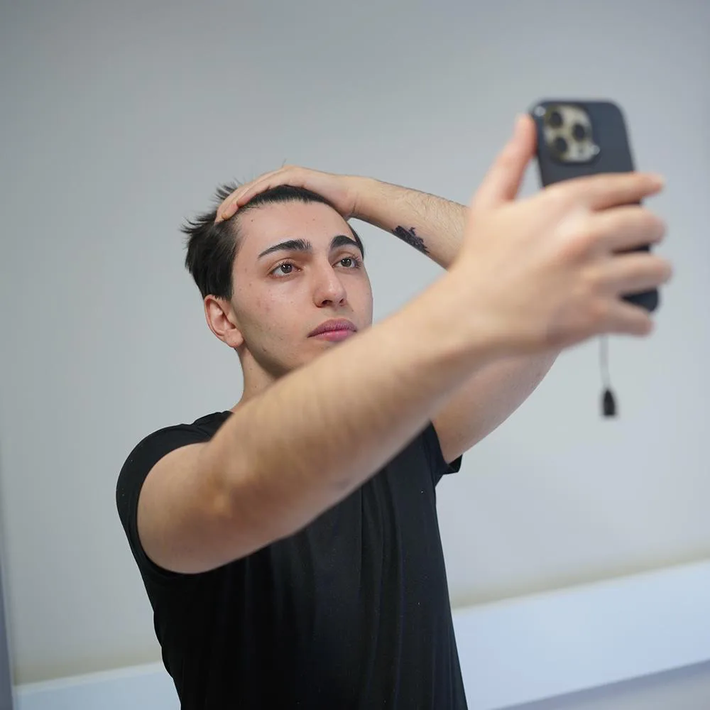 Young man photographing his hairline with a phone to check hair loss before a hair transplant in Turkey