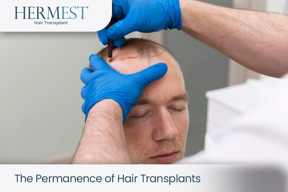 The Permanence of Hair Transplants