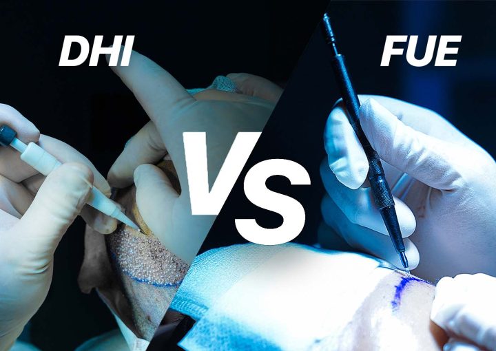 DHI vs FUE Hair Transplant: Which Is Better? 17 dhi vs fue hair transplant comparison