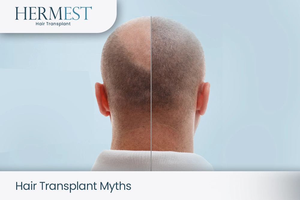 Unmasking Hair Transplant Myths