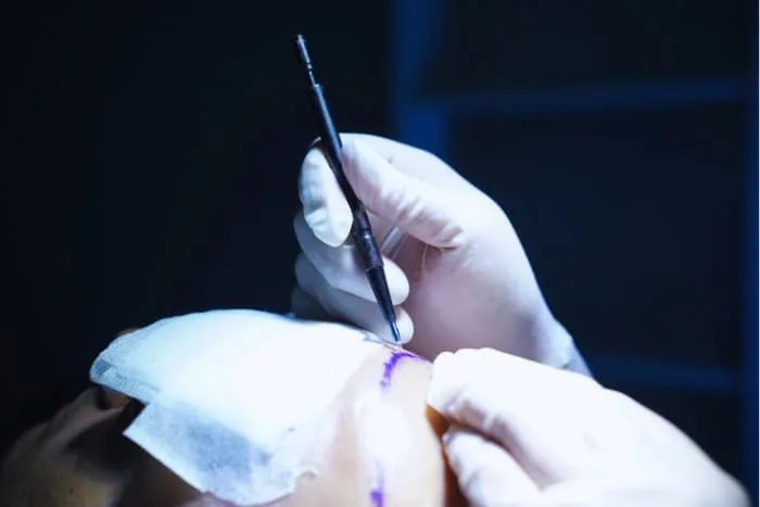 Advantages of Sapphire FUE Hair Transplant Technique in Turkey