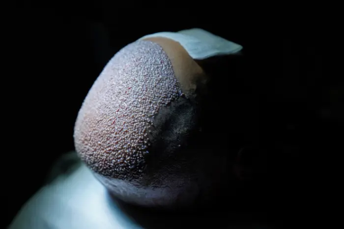 How a 4000 Grafts Hair Transplant Can Deliver Natural Results