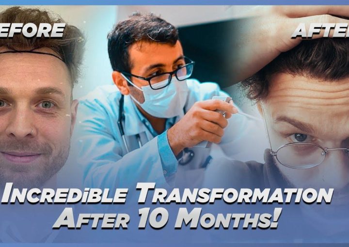 Success Rates of Hair Transplants in Turkey: What to Expect 11 Success Rates of Hair Transplants in Turkey