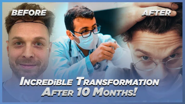 Success Rates of Hair Transplants in Turkey
