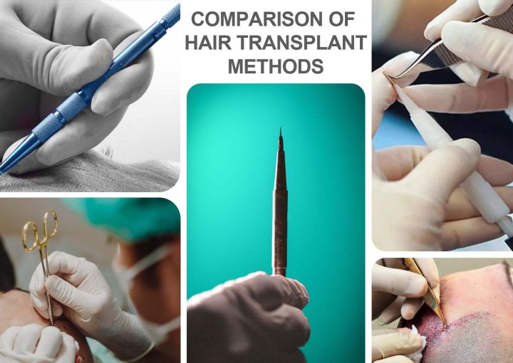 Best Hair Transplant Methods 10 A comparison chart illustrating the effectiveness, patient satisfaction rates, and success rates of different hair transplant methods, including Unique FUE, Sapphire FUE, DHI, Slit FUE, Robotic FUE, and FUT